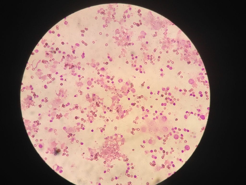 Farvet mikroksopipræperat af finnålsaspirat fra hun hund med inflammatorisk carcinom mammaetumore