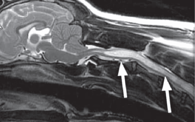 En MR-scanning af en patient med syringomyeli. Væskeophobningen i rygmarven vises som næsten hvid (hvide pile).